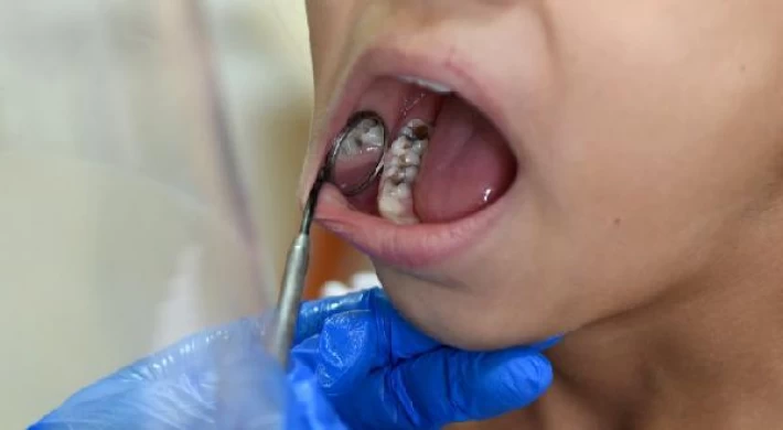 Tedavi edilmeyen diş iltihabında ölümcül ’mediastinit’ riski