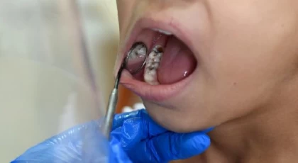 Tedavi edilmeyen diş iltihabında ölümcül ’mediastinit’ riski