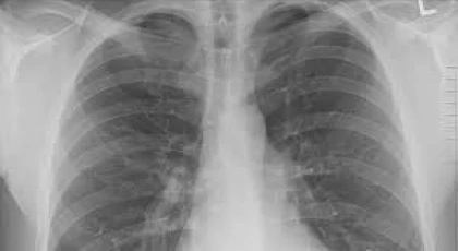 Kirli hava akciğer kanseri sebebi